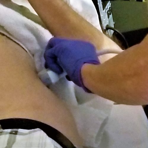 Saiba o que é a Calculose Urinária ou pedra nos rins