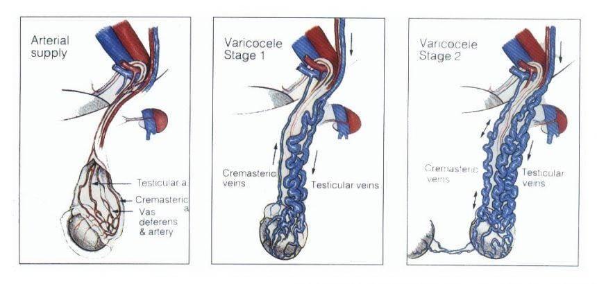 Varicocele Quando Operare E Quando No