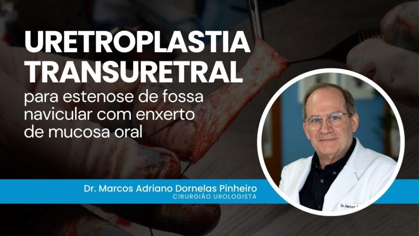 Uretroplastia transuretral para estenose de fossa navicular com enxerto de mucosa oral