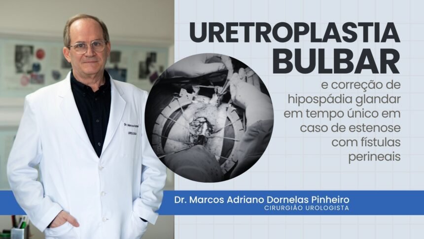 Uretroplastia bulbar e correção de hipospádia glandar em caso de estenose com fístulas perineais.