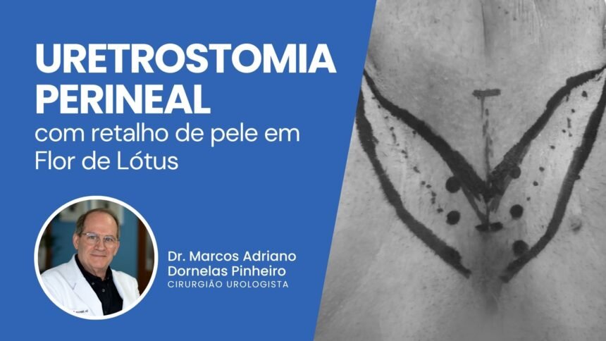 Uretrostomia perineal com retalho de pele em flor de lótus