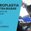 Uretroplastia de uretra bulbar com enxerto de mucosa oral