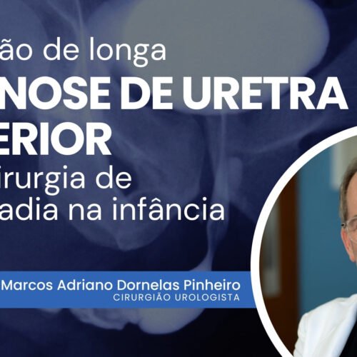 Correção de longa estenose de Uretra Anterior após cirurgia de hipospadia na infância