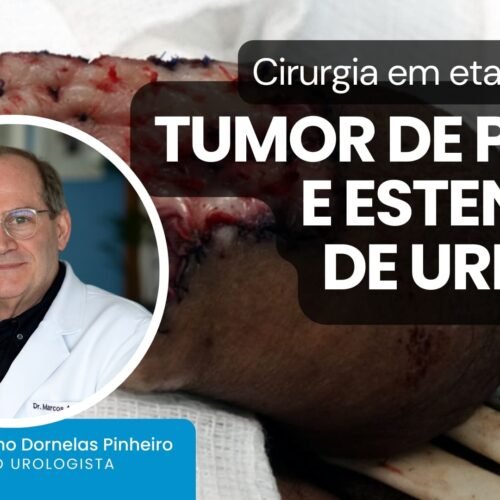 Cirurgia em etapas para tumor de pênis e estenose de uretra