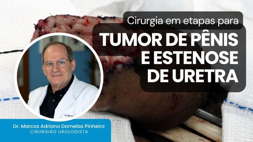 Cirurgia em etapas para tumor de pênis e estenose de uretra