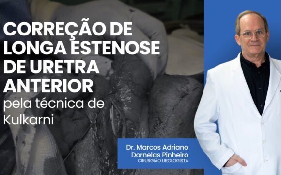 Correção de longa estenose de uretra anterior pela técnica de Kulkarni