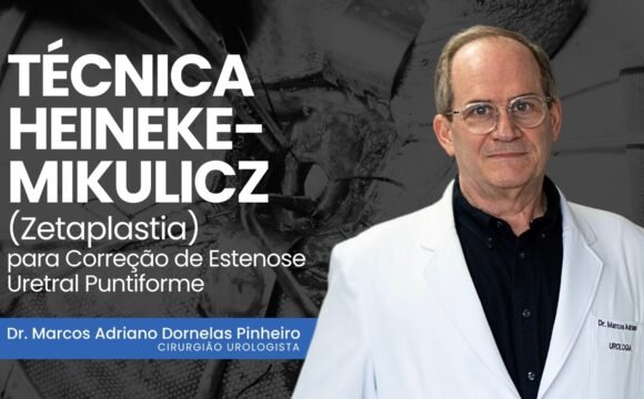 Técnica Heineke-Mikulicz (Zetaplastia) para Correção de Estenose Uretral Puntiforme