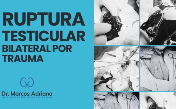 Ruptura Testicular bilateral por trauma