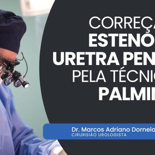 Correção de estenose de uretra peniana pela técnica de Palminteri