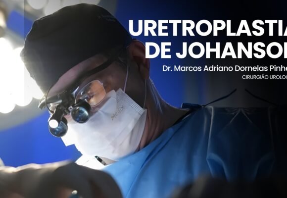 Uretroplastia em estenose uretral complexa – técnica de Johanson