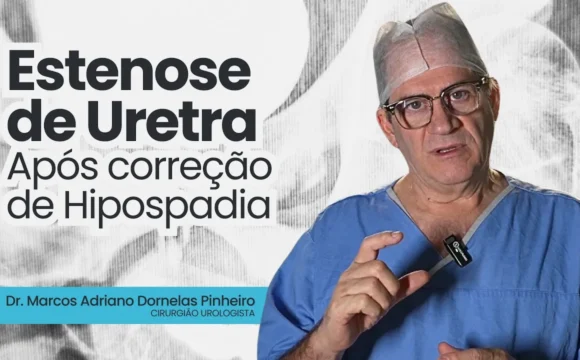 maxresdefault Cirurgia Urológica Uretroplastia por Etapas com Enxerto de Mucosa Oral