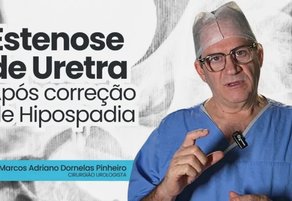 Cirurgia Urológica Uretroplastia por Etapas com Enxerto de Mucosa Oral